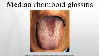 Median rhomboid glossitis [upl. by Akimak447]