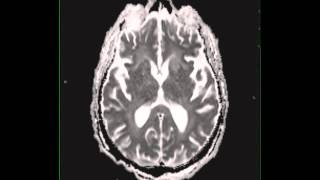 Cryptococcal meningitis [upl. by Van]