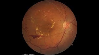 Treatment for Retinal Vein Occlusion [upl. by Disharoon]