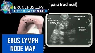 Flexible Bronchoscopy Basic Techniques 5  Brushing [upl. by Nodyl501]