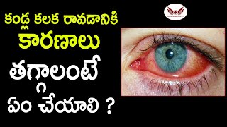 కండ్ల కలక తగ్గాలంటే  Conjunctivitis  Kalla Kalaka  Eagle Health [upl. by Jeffie]