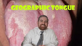 Geographic Tongue A Clinical Review [upl. by Barbe153]