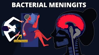 Bacterial Meningitis  Symptoms Diagnosis Treatments amp Pathology [upl. by Wildee]