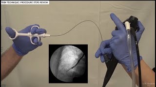 Transbronchial Biopsies  BAVLS [upl. by Gitt]