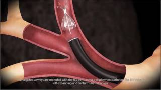 Bronchial Blockers EZBlocker [upl. by Ssenav]