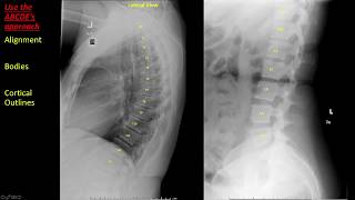 Introduction to Spine Radiographs [upl. by Strait357]