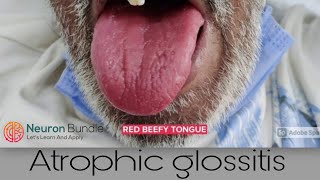 Atrophic glossitis BeefyRedTongue medschool clinicalexamination [upl. by Nath]