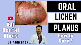 ORAL LICHEN PLANUS  HOW TO CURE [upl. by Botzow]