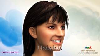 Malocclusion  Different Types [upl. by Eissirc]