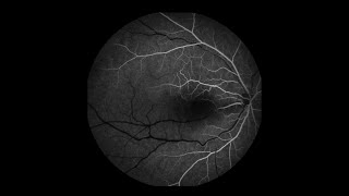 Pulsating Cilioretinal Artery From Elevated Eye Pressures [upl. by Ranie]