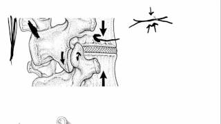 Osteoarthritis  causes symptoms diagnosis treatment amp pathology [upl. by Kenta390]