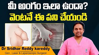 Best Treatment for Phimosis in Telugu  KSR Stapler Circumcision  Treatment Range Hospital [upl. by Ronym]