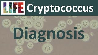 Diagnosing cryptococcal meningitis [upl. by Aicirtel639]