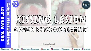 Median rhomboid glossitis  Kissing lesion  Central papillary atrophy  Dr Paridhi Agrawal [upl. by Hafital857]