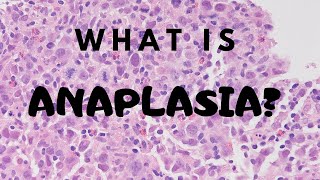 What is Anaplasia  Pathology mini tutorial [upl. by Edmead]