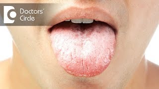 Causes and symptoms of oral thrush  Dr Jayaprakash Ittigi [upl. by Dlabihcra]