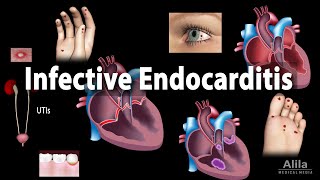 Infective Endocarditis Animation [upl. by Lu]