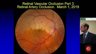 Retinal Artery Occlusion [upl. by Ollayos]