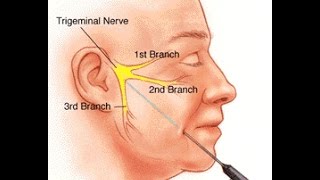 Trigeminal Neuralgia [upl. by Celestina600]