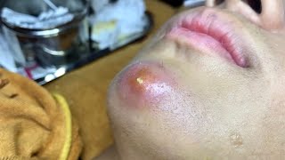 Pimple Popping 2020 Video 65 Blackheads removal Acne removal Acne treatment [upl. by Mickelson]