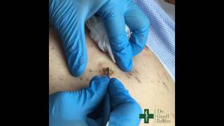 Removal of Seborrheic Keratosis [upl. by Anelaj]