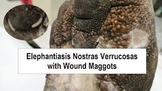 Elephantiasis Nostras Verrucosas and Wound Maggots [upl. by Adnilemreh]