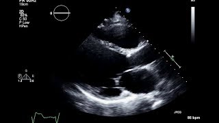 Ischemic Cardiomyopathy 2D Echocardiogram [upl. by Atnim]