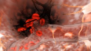 Hemorrhagic Stroke Brain Hemorrhage [upl. by Lletniuq]