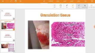 Granulation tissue 1st step of repair [upl. by Atinniuq]