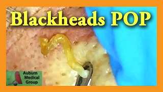 Blackheads POP  Auburn Medical Group [upl. by Pierro]