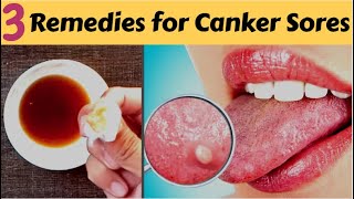 How to Get Rid of Blisters on the Tongue  Home Remedies for Mouth Ulcers [upl. by Sherar]