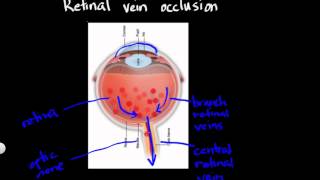 Retinal vein occlusion [upl. by Durno]