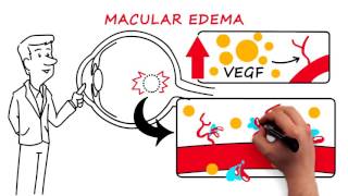 Retinal Vein Occlusion [upl. by Nitsa]