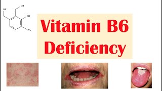 Vitamin B6 Pyridoxine Deficiency  Dietary Sources Causes Signs amp Symptoms Diagnosis Treatment [upl. by Berri]