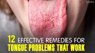 12 Effective Remedies For Tongue Problems That Work  Healthspectra [upl. by Sinnal]