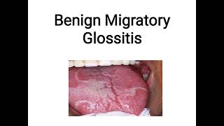 benign migratory glossitis [upl. by Adnilg305]