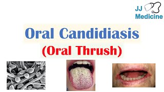 Oral Candidiasis Oral Thrush  Causes Pathophysiology Signs amp Symptoms Diagnosis Treatment [upl. by Denoting156]