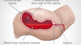 Postpartum Hemorrhage [upl. by Hiltner844]