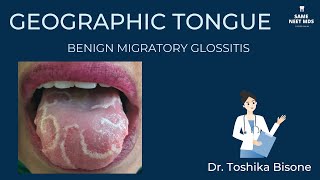 Geographic tongue  Benign migratory glossitis [upl. by Neal311]