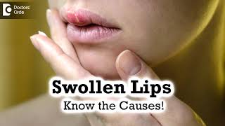 Swollen Lips Common CausesTriggers  Angioedema  Dr Rashmi Ravindra  Doctors Circle [upl. by Berty]