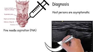 Papillary and Follicular Thyroid Cancer When and How To Treat or Watch and Wait Dr Busaidy [upl. by Groh]