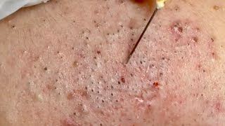 🔥 Pimple Popping 2020 Video Blackheads extraction Blackheads removal Acne removalAcne treatment [upl. by Nimad]