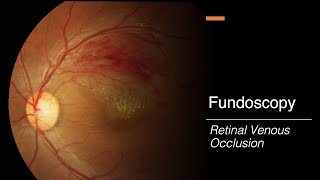 Retinal Venous Occlusion Fundoscopy [upl. by Platus840]