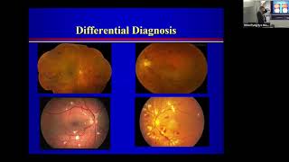 Lecture Retinal Vein Occlusion Dr David Miller [upl. by Rahal]